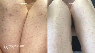 Laser Hair Removal Before and After