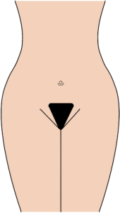 Pubic Hair Transplant