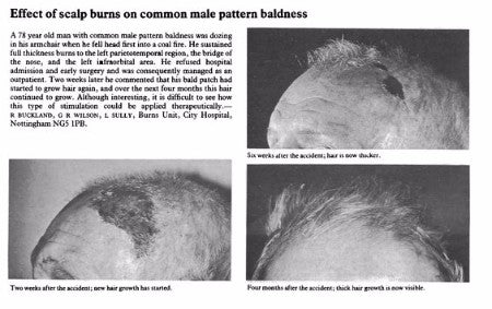 Hair growth after a burn injury.