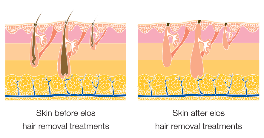 Raleigh Laser Hair Removal