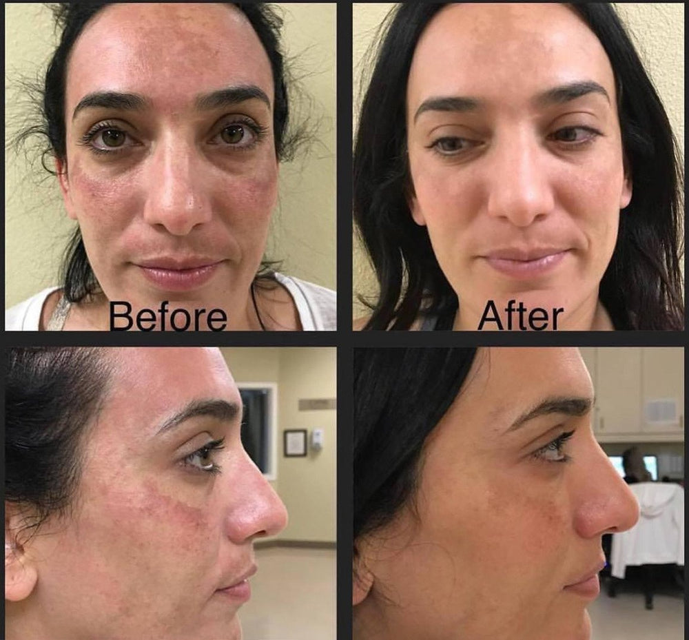 Microneedling Raleigh NC