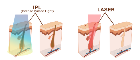 Deciphering the Distinction: IPL vs. Laser Hair Removal