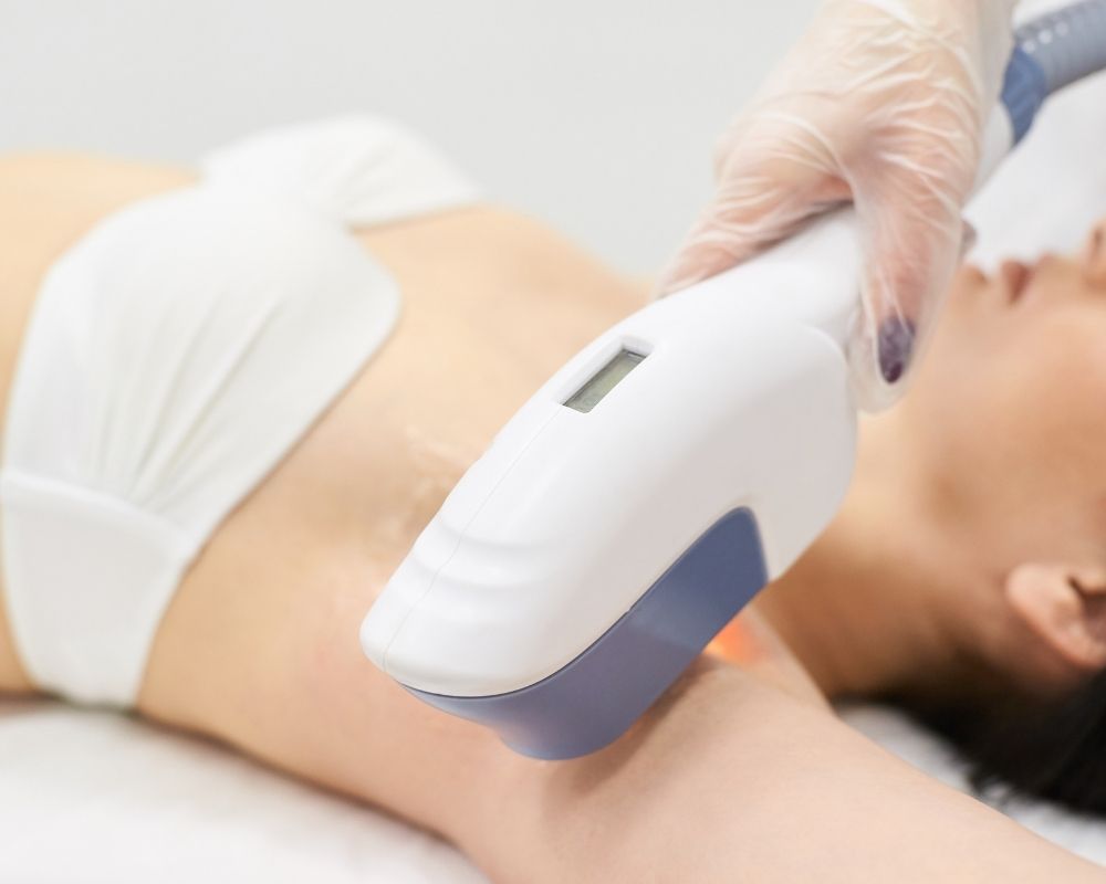 Laser hair removal