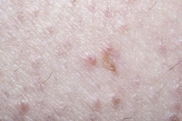 Pseudofolliculitis barbae or in grown hairs after shaving