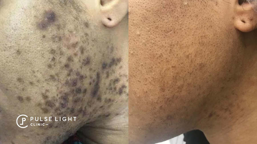 PCOS Laser Hair Removal Face