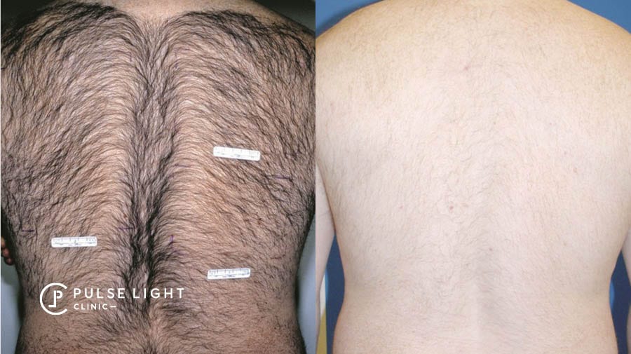 Laser hair removal