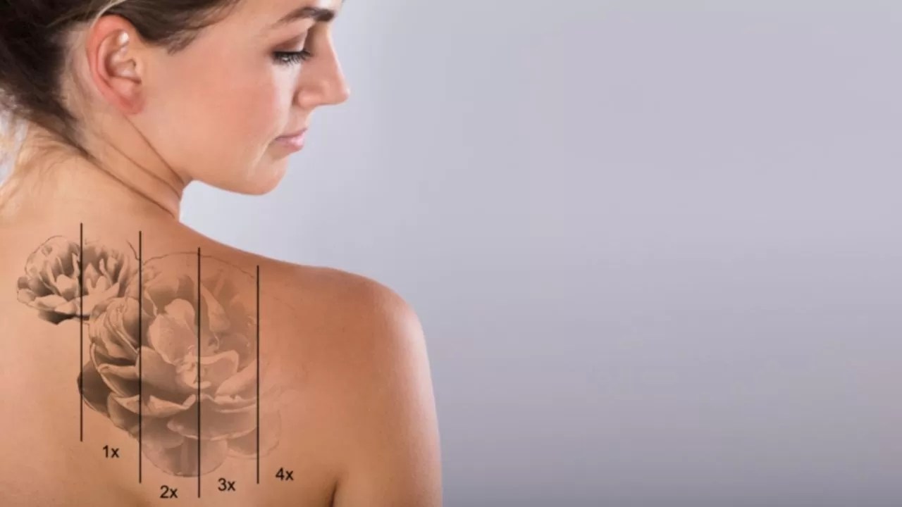 What Is Laser Tattoo Removal - And Does It Hurt?