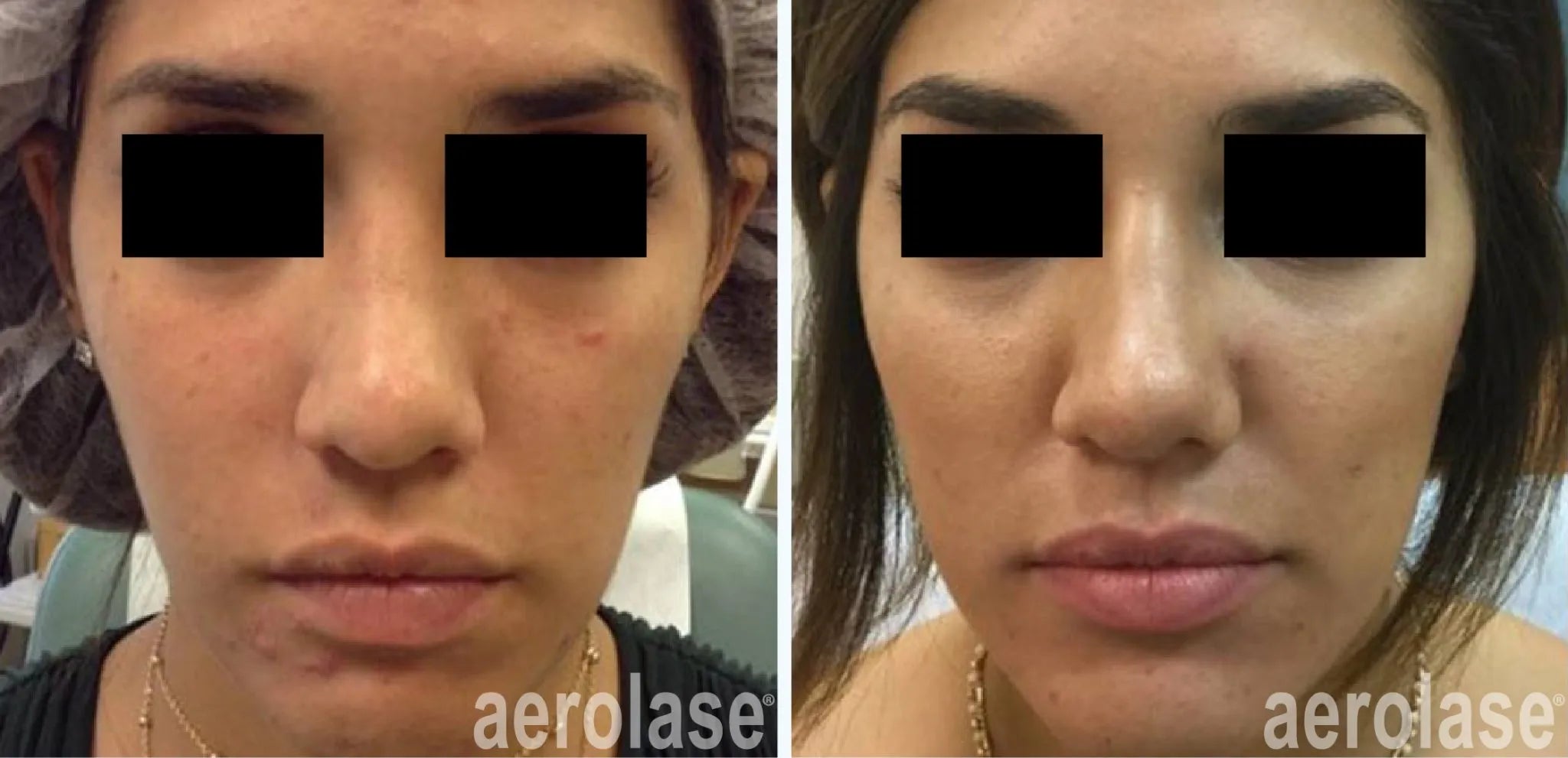 Innovations in Dermatology: The Role of Aerolase Laser in Managing Active Acne