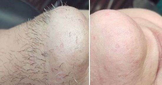 10 Surprising Reasons You Have Chin Hair - And When You Should Worry About It