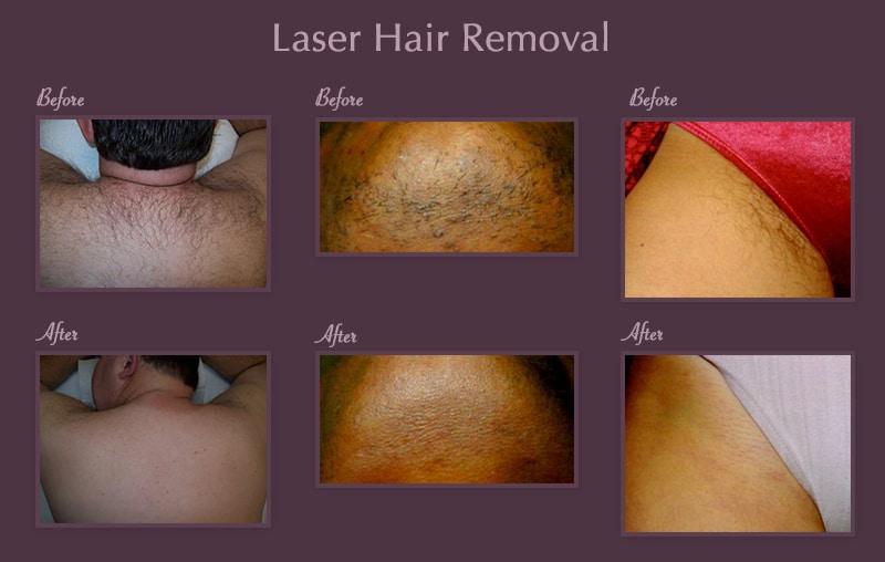 Expert Laser Hair Removal: Accomplish Smooth Skin Effortlessly