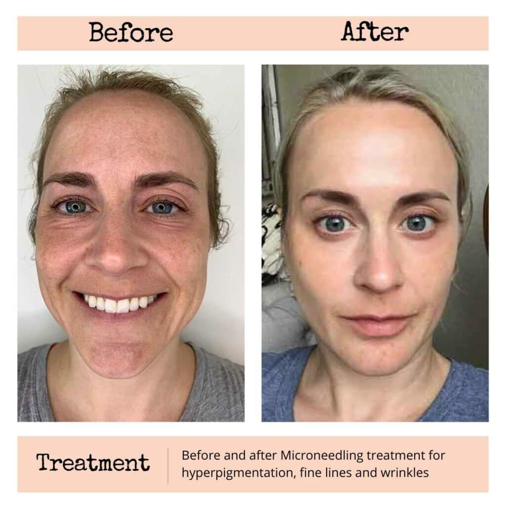 microneedling raleigh nc