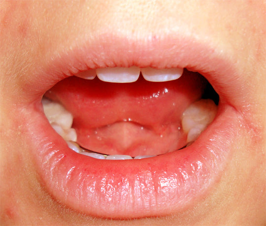 Angular Cheilitis (Perleche, Angular Stomatitis, Cheilosis)