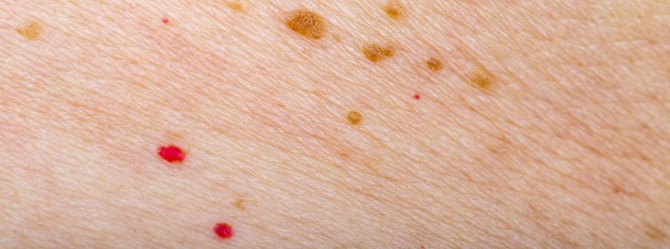 close up of cherry angiomas red spots on skin with moles