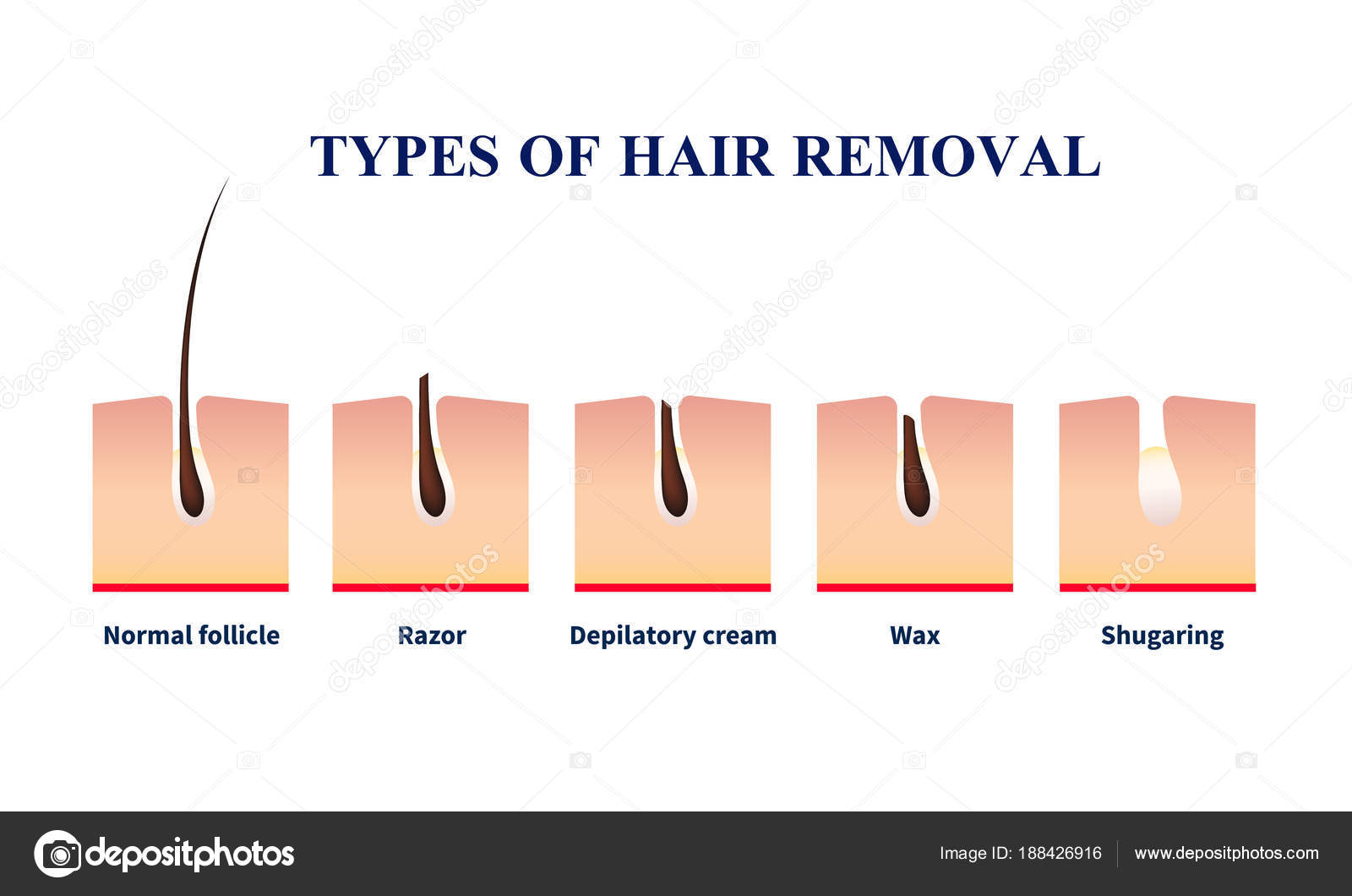 Laser Hair Removal Near Me