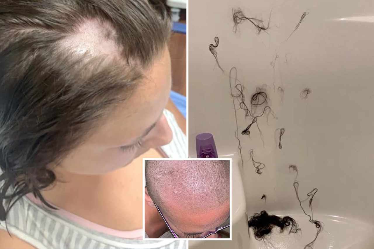 Woman, 21, shaves her head after her hair fell out when she used ‘tampered’ conditioner ‘mixed with hair removal cream’