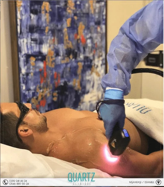 Laser Hair Removal