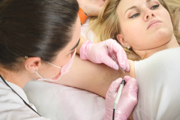 electrolysis hair removal - what is electrolysis - electrolysis vs laser hair removal