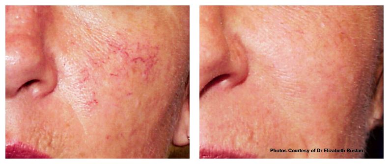 Facial veins/ damaged capillaries/ rosacea treatment of undesirable