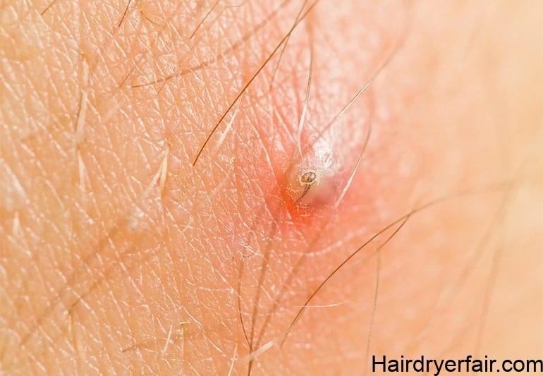 What is Best for Ingrown Hair: The Complete Guide 1