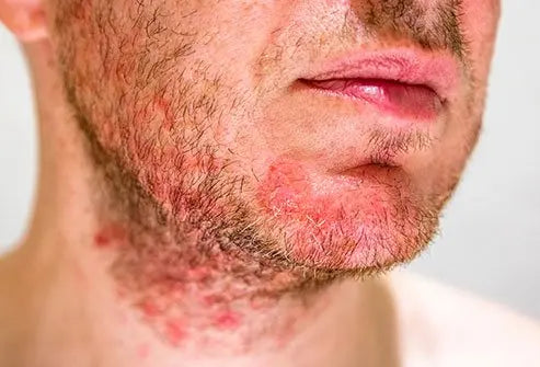 If folliculitis goes untreated it may result in serious or deep infections that may spread or cause permanent scarring, cellulitis, or even enter the bloodstream and become life-threatening.