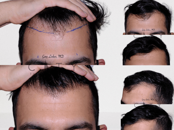 hair-transplant-nyc-case-1-removebg-preview - Services Dictionary