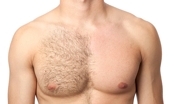 Everything you need to know about IPL hair removal for men