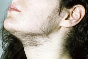 Straight, No Chaser: Hirsutism (Abnormal Female Hair Growth)