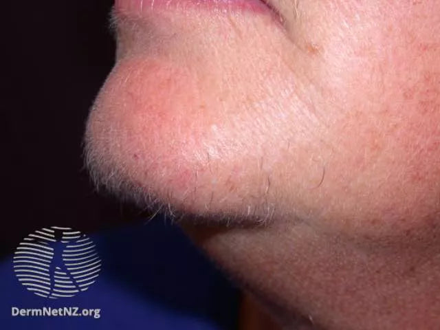 Hirsutism on chin.