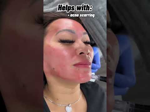 Hollywood Microneedling