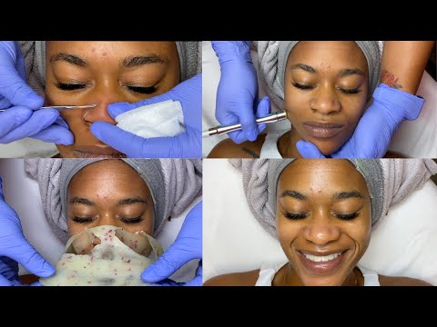 Hollywood Microneedling