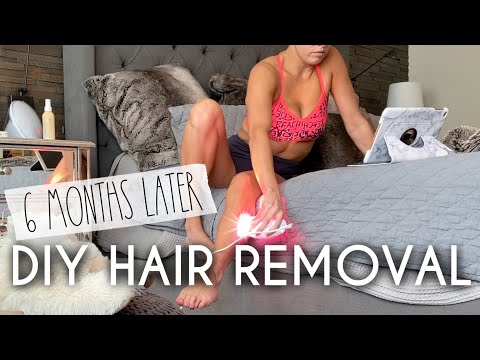 Six Months with the Kenzie IPL Hair Removal Device: An In-Depth Review