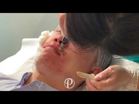 Hollywood Microneedling