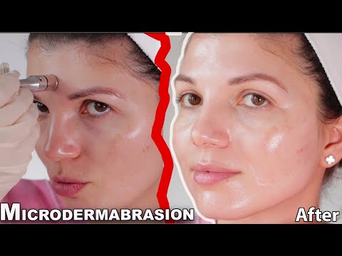 Hollywood Microdermabrasion