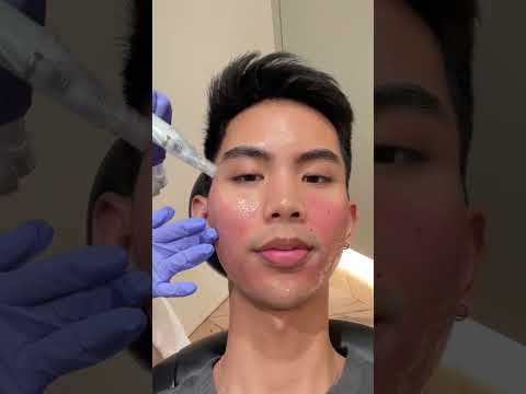 Hollywood Microneedling