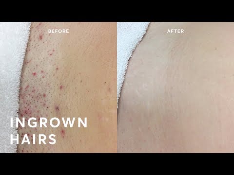 How to get rid of ingrown hairs? FOREVER!!!