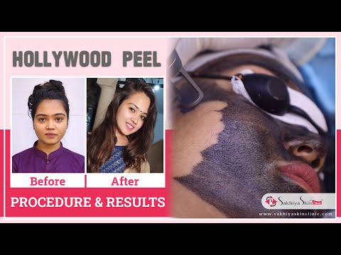 Hollywood Microneedling