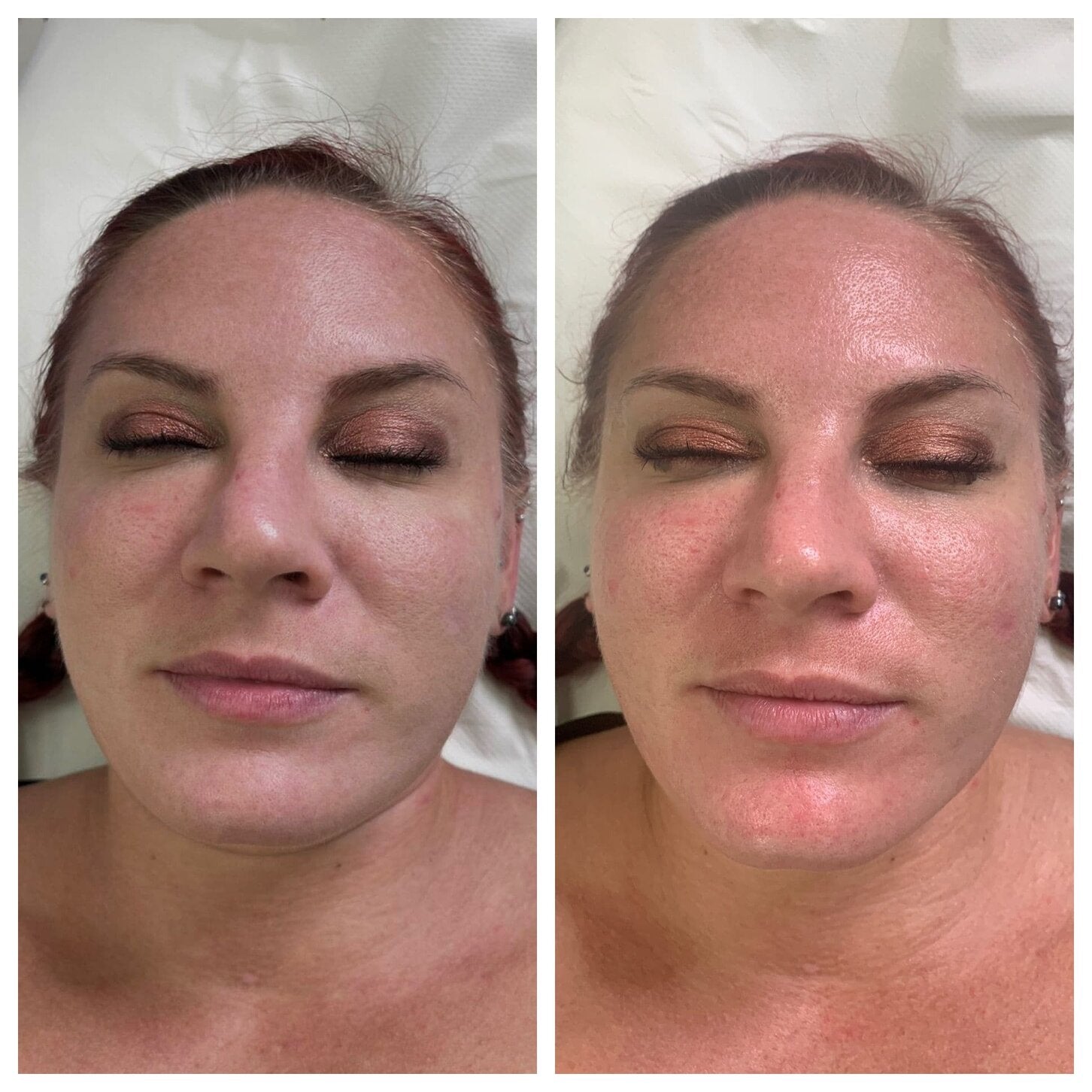 Nashville Chemical Peel