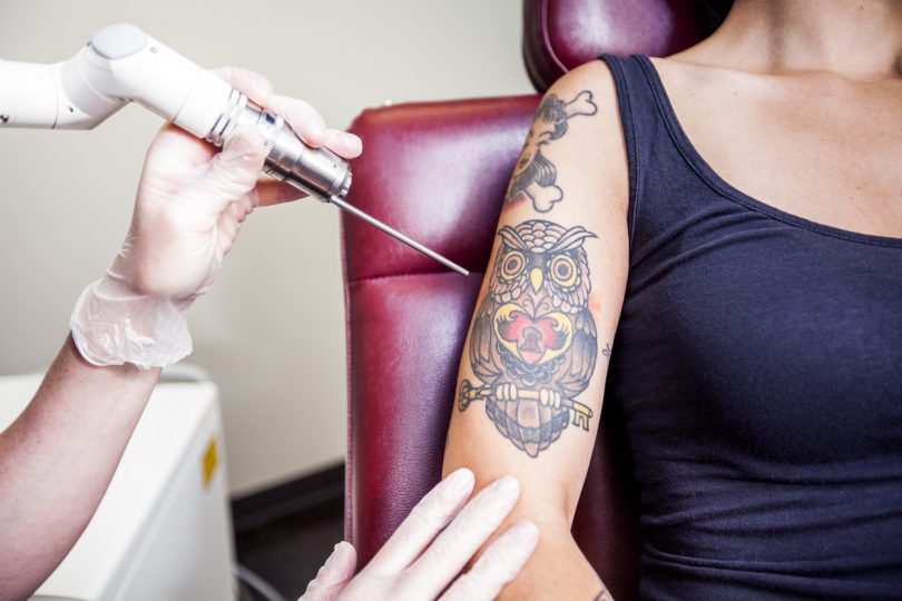 Where are the best laser tattoo removalists in Canberra? Photo: File.