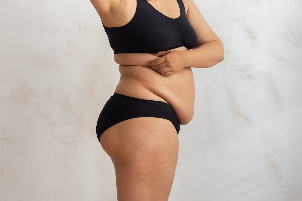 Can You Tighten Loose Skin After Extreme Weight Loss