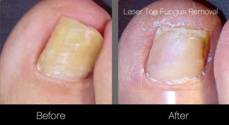 Toe Fungus Treatment (Laser Treatment) Toronto