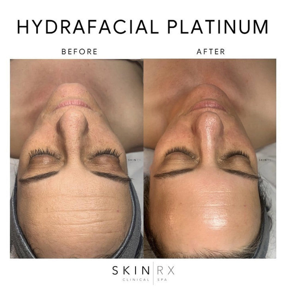 Nashville Hydrafacial