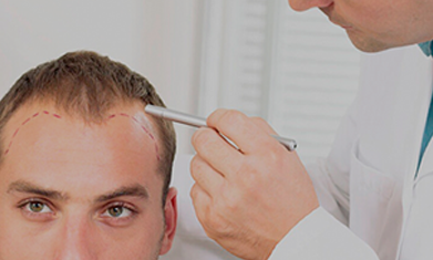 How Much Does A Hair Transplant Cost In Calicut?