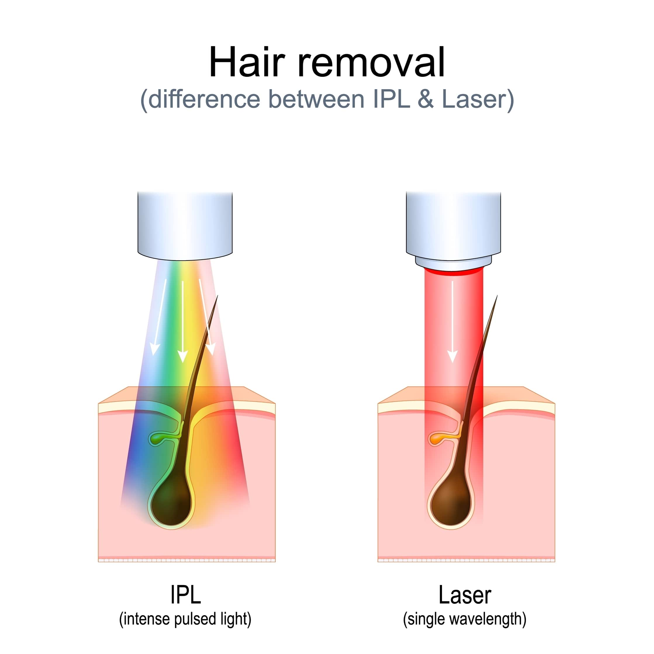 IPL vs Laser Hair Removal