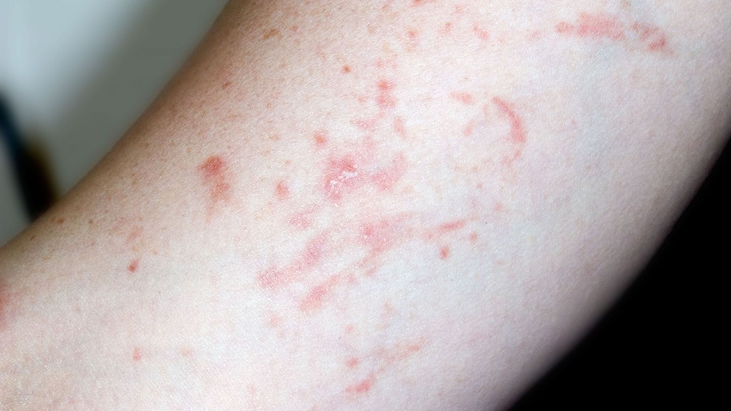 Repeatedly scratching an itchy plaque can cause new streaks of psoriasis to appear a few days, weeks, or possibly even years later.