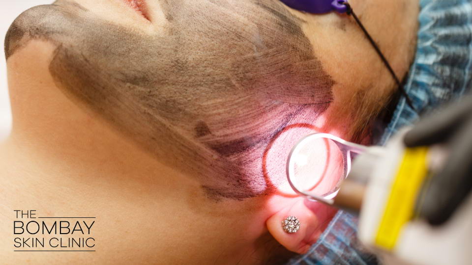 Laser Skin Treatments