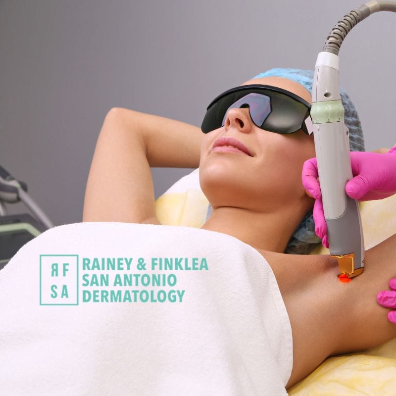 Laser Hair Removal in San Antonio, TX