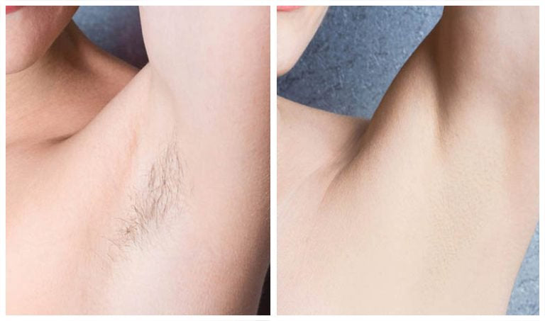 Laser Hair Removal 767 768x453