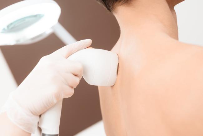 laser hair removal for men