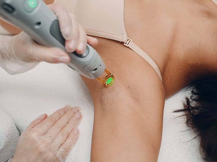 Laser Hair Removal