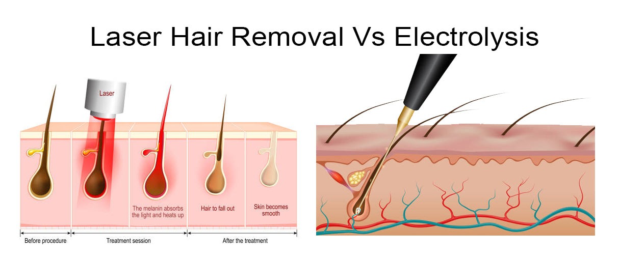 Electrolysis vs Laser Hair Removal: Choosing the Right Method for Lasting Hair Removal